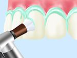 STEP02歯の清掃と研磨